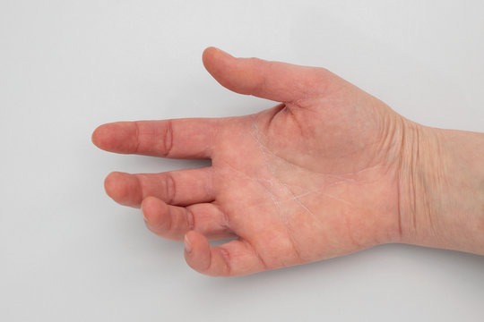 very dry skin in womans hand on gray background