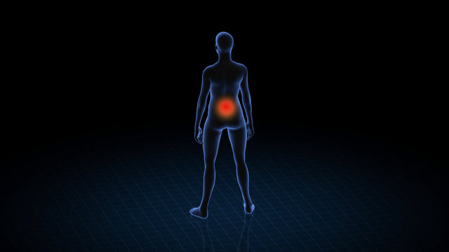 Girl with pathology. 3d body of women. Female human figure.