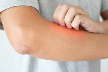 Young asian man itching and scratching on arm from itchy dry skin eczema dermatitis