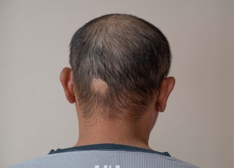 円形脱毛症