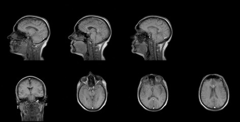 set of serial MRI scans of sixty years old caucasian female head in sagittal and horizontal planes