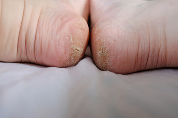 The Heel Of The Foot With Bad Skin Is Covered With Cracks. White Background. Pain. Monitor feet skin condition to prevent skin breakdown and trauma.