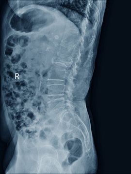 MRI of lumbar spine  the study reveals burst fracture of L2 vertebral body