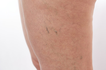 legs of a 40-year-old woman with stretch marks, cellulite and varicose veins close-up