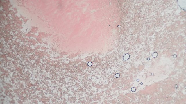 Fresh blood seen on a 40x microscope view. Blood smear under microscope present plasma, white and red blood cells.