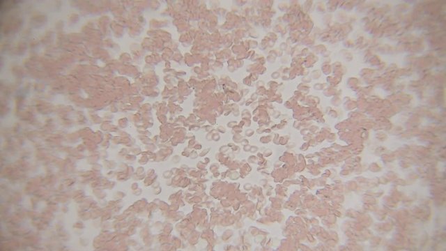 Fresh blood seen on a 400x microscope view. Blood smear under microscope present plasma, white and red blood cells.