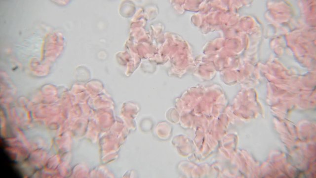 Fresh blood seen on a 1000x microscope view. Blood smear under microscope present plasma, white and red blood cells.
