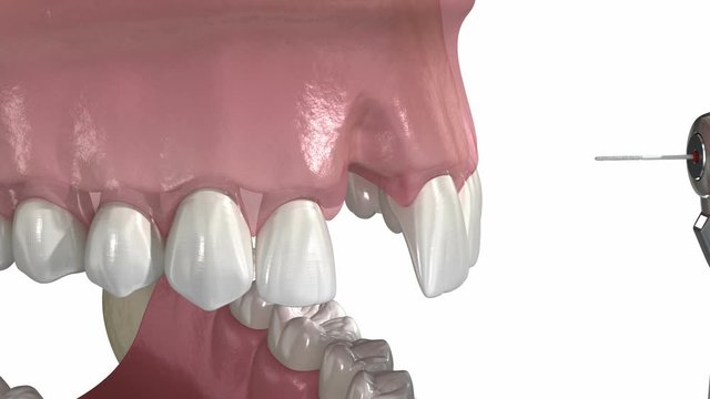 Bone grafting- augmentation using block of bone, tooth implantation. Medically accurate 3D animation.