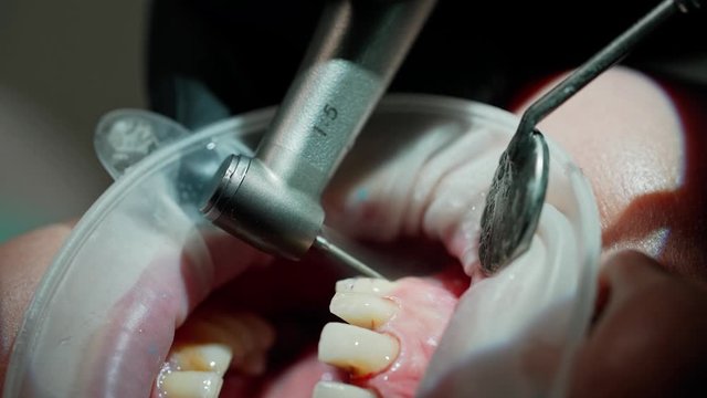 Patient's mouth during tooth treatment. Dentist's hands working with dental tools to treat sick tooth. Stomatology procedure. Close-up.