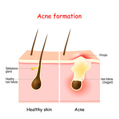 Acne. Inflamed pimple on the human skin.