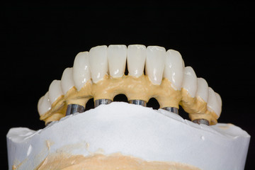Dental prosthetics on implants, artificial jaw with dentures on the table in the dental office