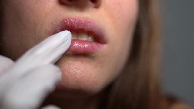 Weak immune system causing viral herpes appearing on human lips. Young woman suffering from herpes on her upper lips, body dehydration and loss of vitamins. Herpes simplex virus