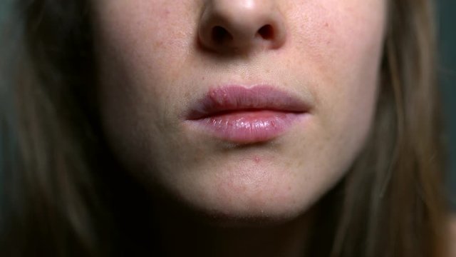 Stressed and tired females face with herpes sores on her upper lip. Weak immune system, loss of vitamins and unhealthy lifestyle causing herpes simplex virus appearing. Suffering from herpes infection