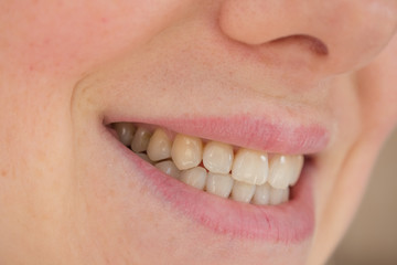  chips on the front teeth. concept of dentistry and oral hygiene