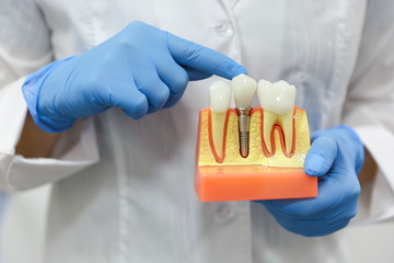 dental concept. the hands of a dentist doctor hold a model of teeth with a dental implant - obrazy, fototapety, plakaty