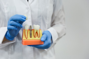 dental concept. the hands of a dentist doctor hold a model of teeth with a dental implant