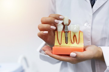 dental concept. the hands of a dentist doctor hold a model of teeth with a dental implant