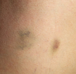 Fototapeta premium Bruise on human skin as a background.