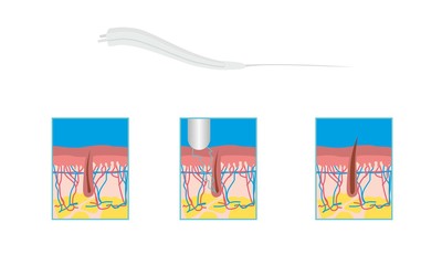 Hair and skin cutout, electric treatment