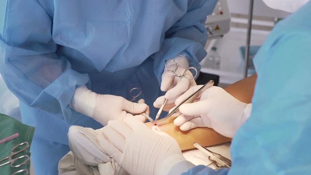 Venous surgeon performs laser coagulation on the leg.Treatment of varicose veins.