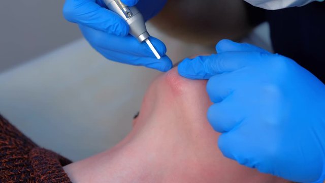 Surgeon removing scar on woman's chin using laser, burning skin, beauty treatment, closeup view. Cosmetic treatment in clinic. One day surgery concept. Removing mark after wound surgical procedure.