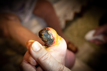 Gangrene of the toe of an old grandmother. Nail blackening, tissue necrosis. Clear boundaries.