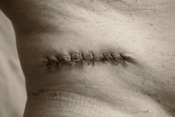 Department of Oncology Surgery. A picture of a postoperative medical suture after removal of a malignant tumor - moles. Malignant melanoma. Black and white image. Sepia, shade of silver.