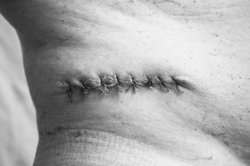 Department of Oncology Surgery. A picture of a postoperative medical suture after removal of a...