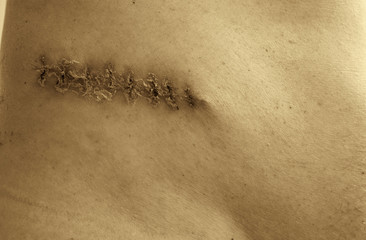 The picture shows a medical scar after surgery after removal of a malignant tumor - a bad...