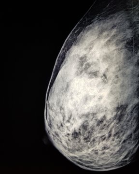 X-ray of a female breast