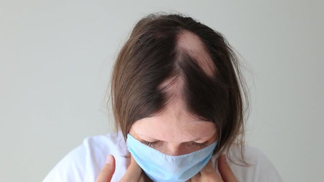 Real alopecia areata in a young girl. A bald head in a person. Diffuse alopecia. Androgenic alopecia. Hair loss. Bald spots on the head. Trichology