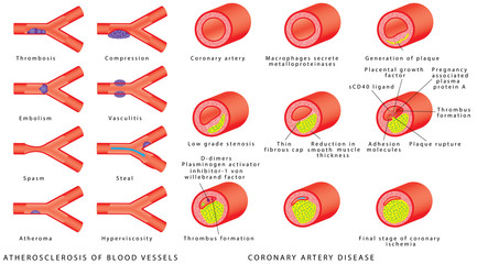 Blood vessels - arteries. Atherosclerosis of blood vessels. Healthy and narrowed arteries with plaques. Pathophysiology of coronary artery disease. The accumulation of cholesterol in the blood vessels