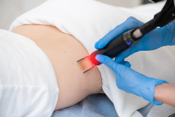 Laser scar removal. Beautician removes a scar with a laser.