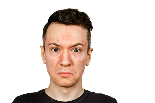 Portrait of young man with allergy, with red face, isolated