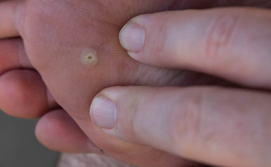 Close up shot of a warty Caucasian man's foot. The fingers of the hand inspect the skin near the infected area.