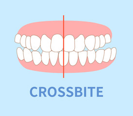 orthodontics  illustrations ; cross bite tooth