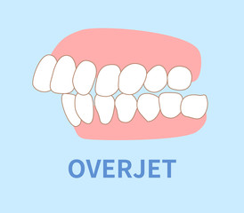 orthodontics  illustrations ; over jet tooth