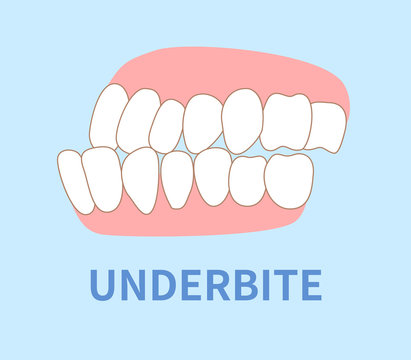 orthodontics  illustrations ; under bite tooth