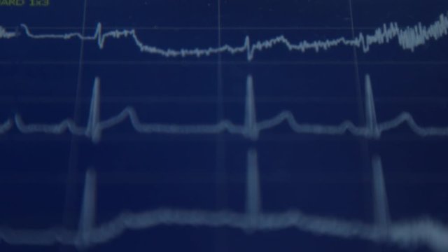 EKG machine showing the blood pressure waves
