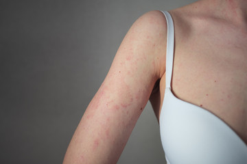 the girl has dermatitis on the arm and shoulder on a gray background