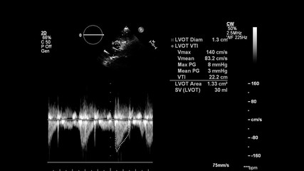 Image of the heart in gray-scale mode during transesophageal ultrasound.