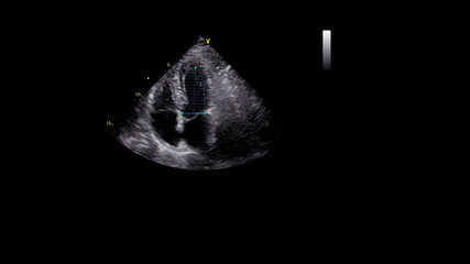 Image of the heart in gray-scale mode during transesophageal ultrasound.