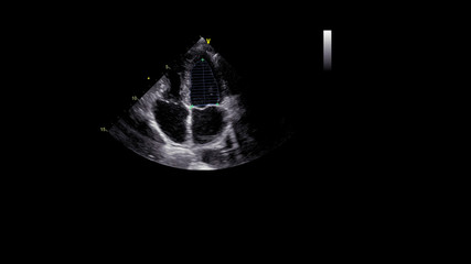 Image of the heart in gray-scale mode during transesophageal ultrasound.