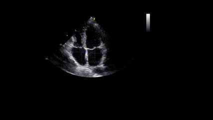 Image of the heart in gray-scale mode during transesophageal ultrasound.