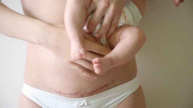Closeup of woman belly with a scar from a cesarean section. Woman with baby on her hand, white bckground and nature light