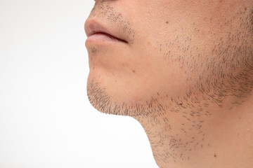 髭脱毛　beforeイメージ　3日間処理してない髭