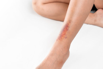 Asian women have bruise on leg from accident on white background.