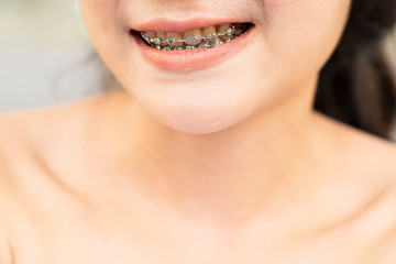 The smile on the face of the girl, Braces concept