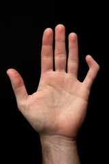 Orthopedic medicine, broken bones. Front view of a broken and deformed little finger of a male...
