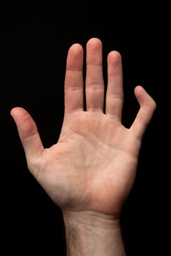 Orthopedic Medicine, Broken Bones. Front View Of A Broken And Deformed Little Finger Of A Male Hand, External Ligament Injury. Black Background